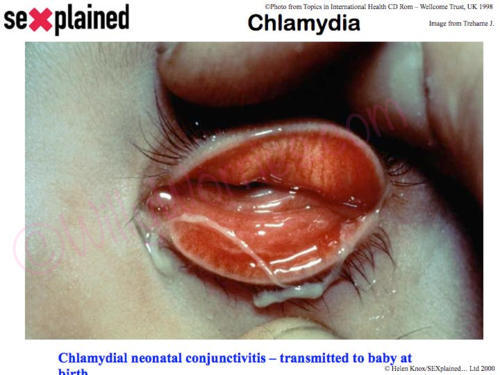 Baby with chlamydial eye infection - transmitted at birth; Chlamydial neonatal conjunctivitis - transmitted to baby at birth