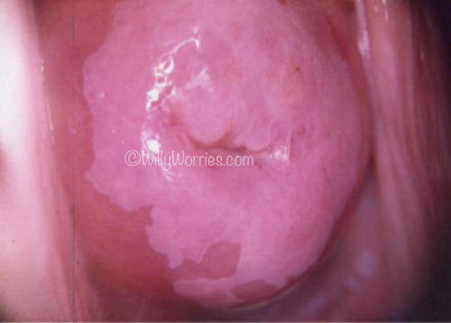 HPV changes and Warts-genital-on-cervix-©Dr.K.C.Mohanty