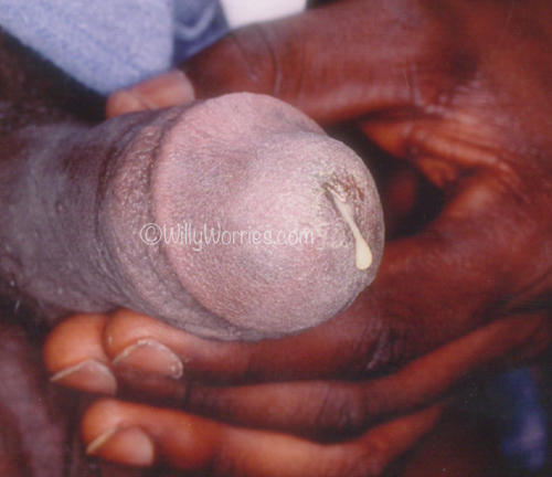 picture of gonorrhoea discharge, penile discharge, gonorrhoea in men, gonorrhoea in women