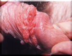 Condylomata-2-Penis-Use.courtesy.of.SSGT.Tony.Gray Condylomata-2-Penis-Use.courtesy.of.SSGT.Tony.Gray
