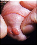 Condylomata-3-Penis-Use.courtesy.of.SSGT.Tony.Gray Condylomata-3-Penis-Use.courtesy.of.SSGT.Tony.Gray