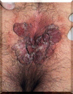 Condylomata-Anal-Use.courtesy.of.SSGT.Tony.Gray Condylomata-Anal-Use.courtesy.of.SSGT.Tony.Gray