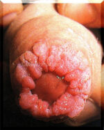 Condylomata-Foreskin-Use.courtesy.of.SSGT.Tony.Gray Condylomata-Foreskin-Use.courtesy.of.SSGT.Tony.Gray